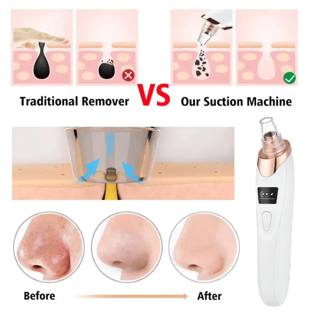 Blackhead Removal Tool